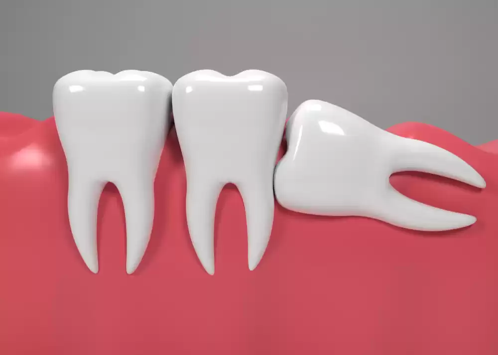 Wisdom Tooth Removal in Noida – Safe, Skilled & Pain-Free