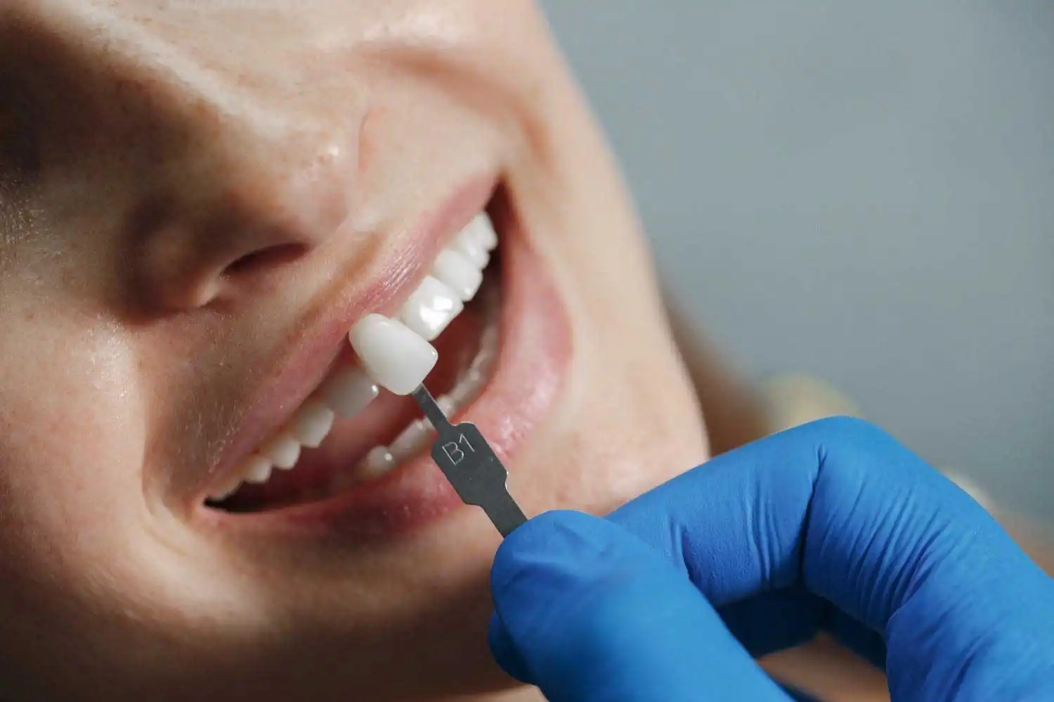 Dental Veneers: Cost, Benefits & Treatment Process